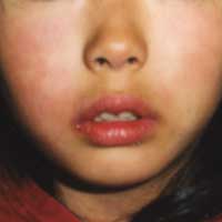 Streptococcal Infection