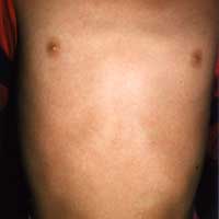 Streptococcal Infection